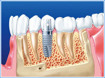 Имплантация зубов с малым сроком остеоинтеграции и иные стоматологические услуги